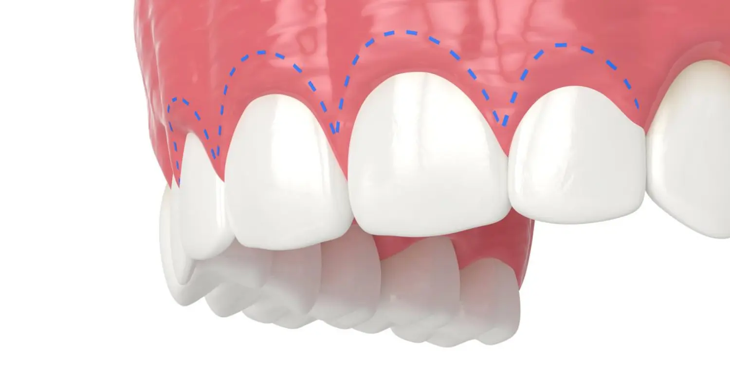 Gum Contouring Risks and Side Effects